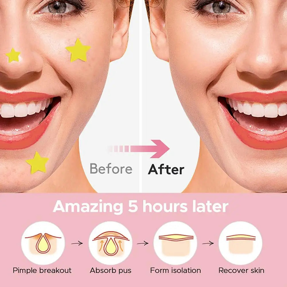 Star Acne Patches™ - Gentle Clear Skin Solution